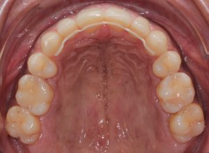 Upper occlusal view after orthodontic treatment showing a well-aligned upper dental arch with a metal-free, eZtain bonded retainer