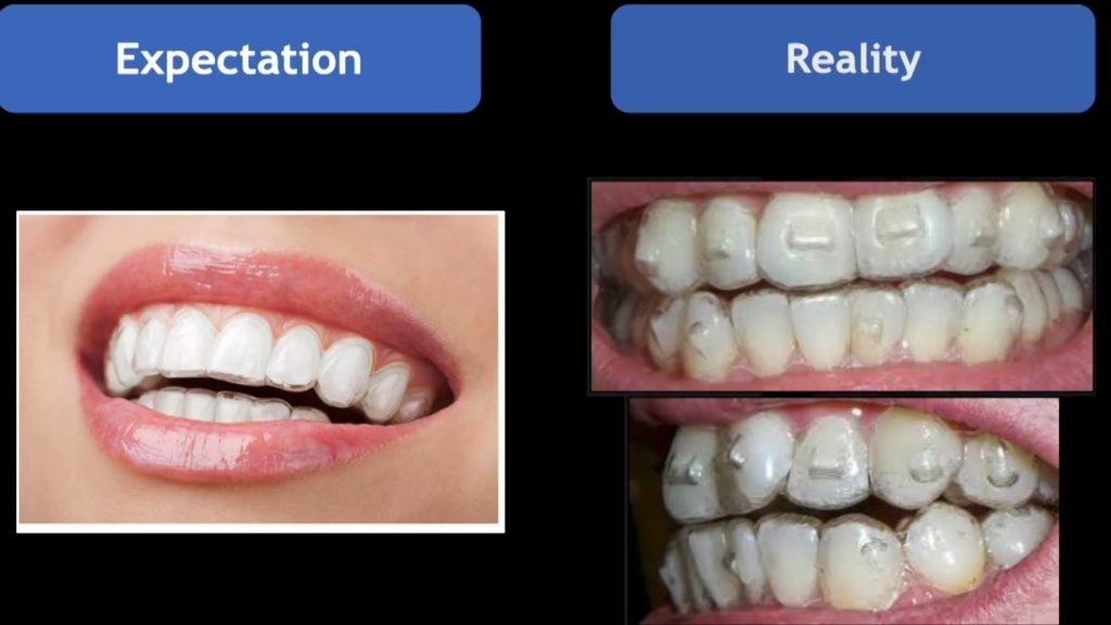 Clear Aligners, expectations vs reality