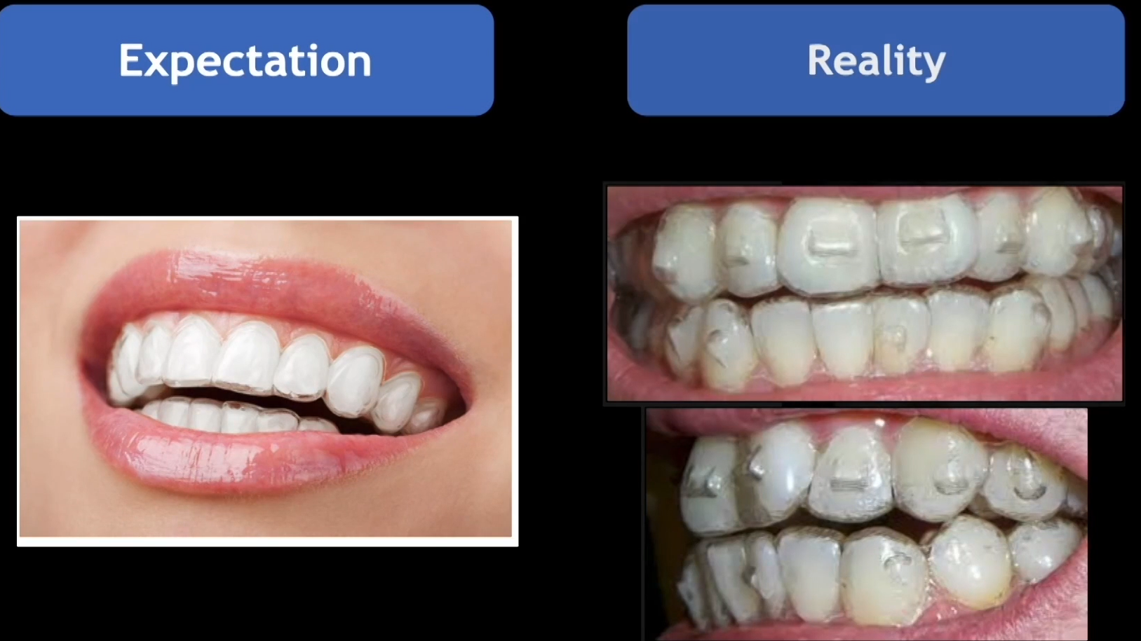 Clear Aligners, Expectations vs reality 