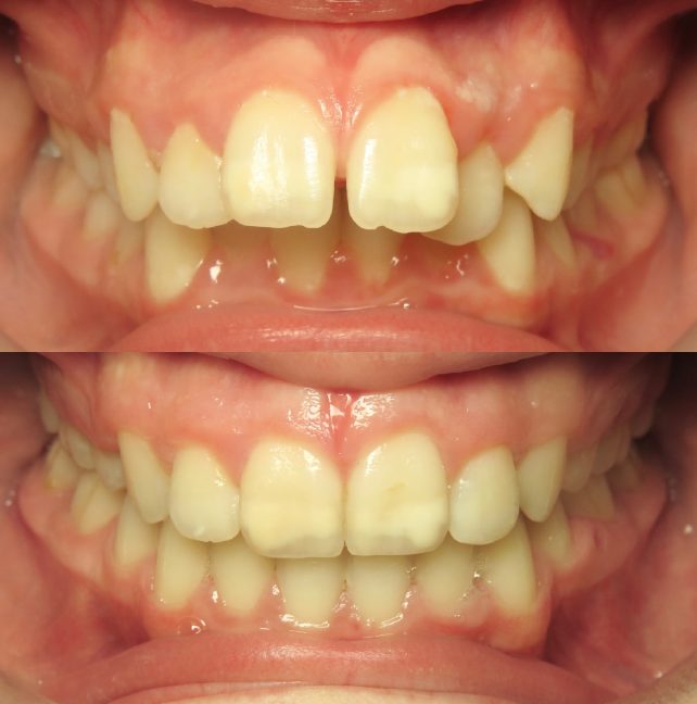 Treatment of protruded teeth