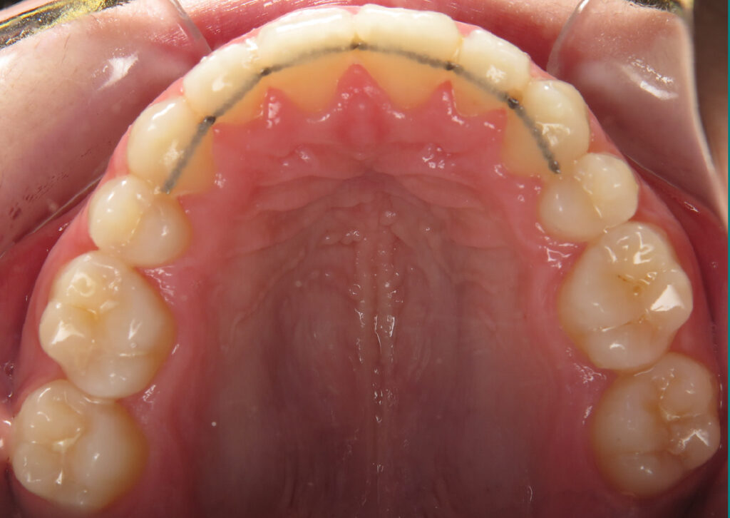 Fixed metal orthodontic wire retainer 