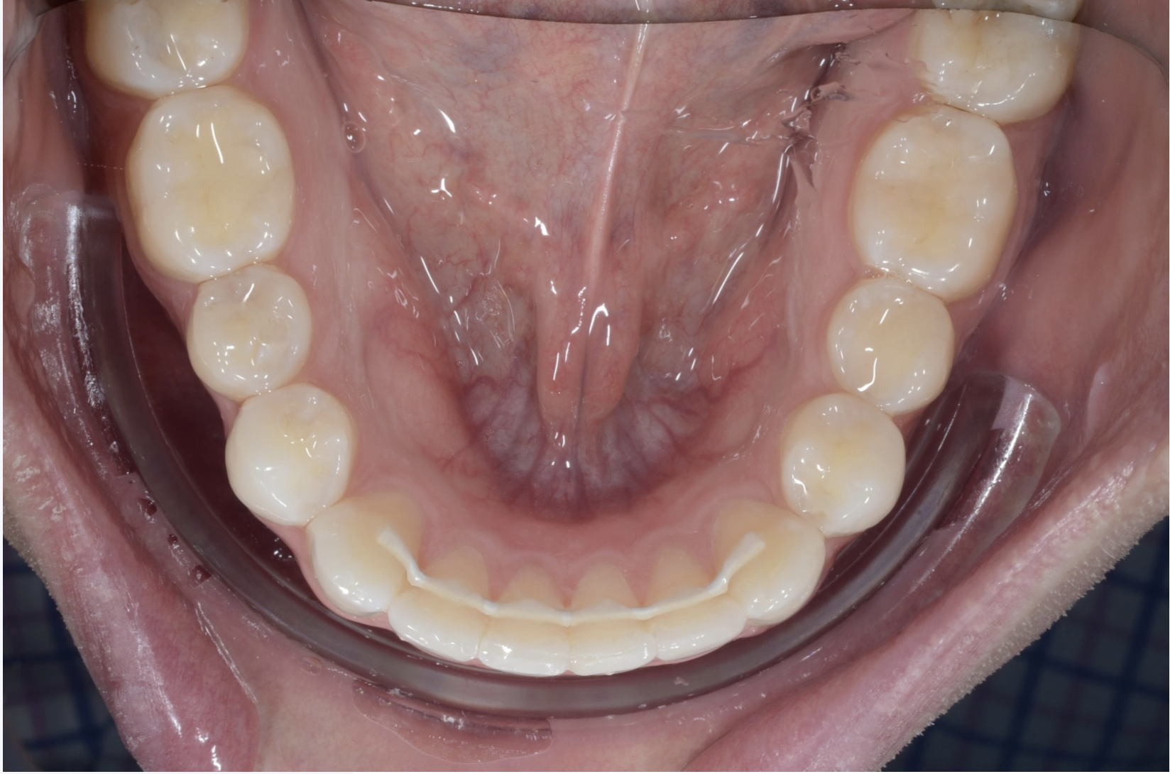 EZtain aesthetic and metal free fixed orthodontic retainer