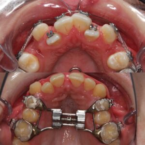 Extractions or Arch Expansion?