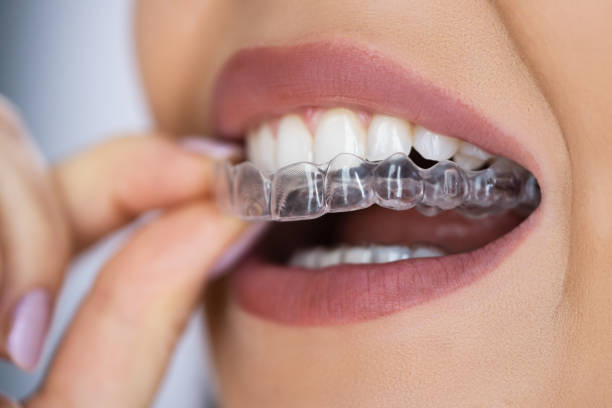 Direct-to-consumer clear aligners