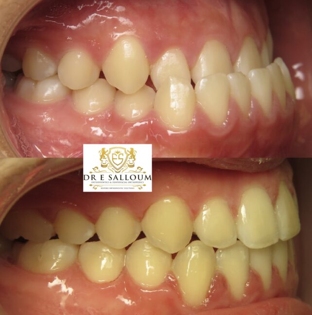non-surgical underbite treatment using fixed braces and TADs