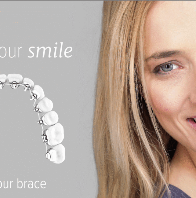 Clear Aligners vs Braces: Which Might Be Better for Busy Professionals?
