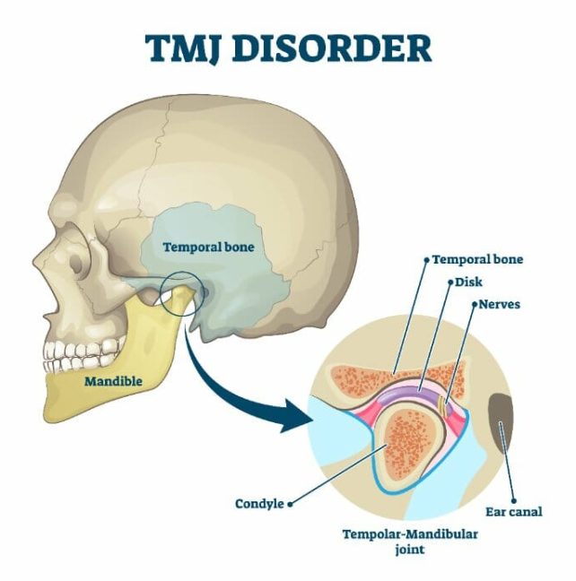 TMJ Disorders