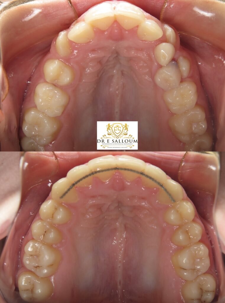 Expansion without extractions