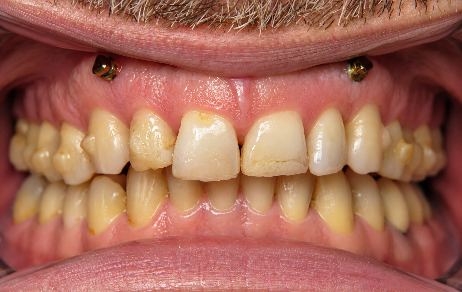 TADs used for gummy smile treatment and orthodontic intrusion