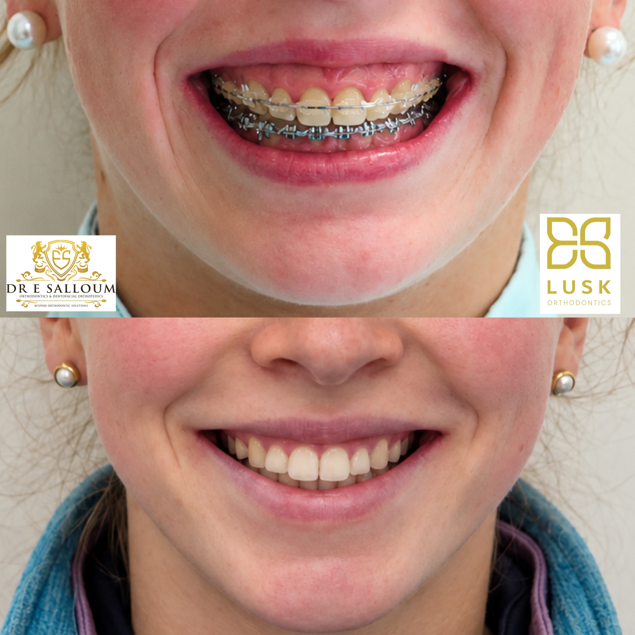 before and after gummy smile treatment without jaw surgery