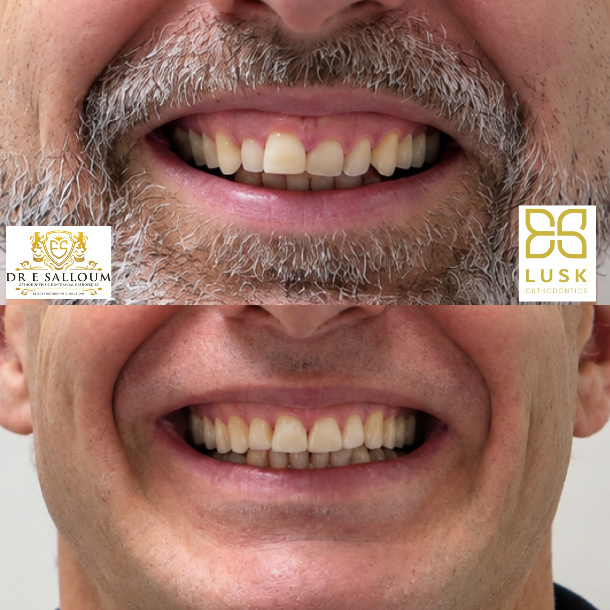 before and after gummy smile treatment without jaw surgery
