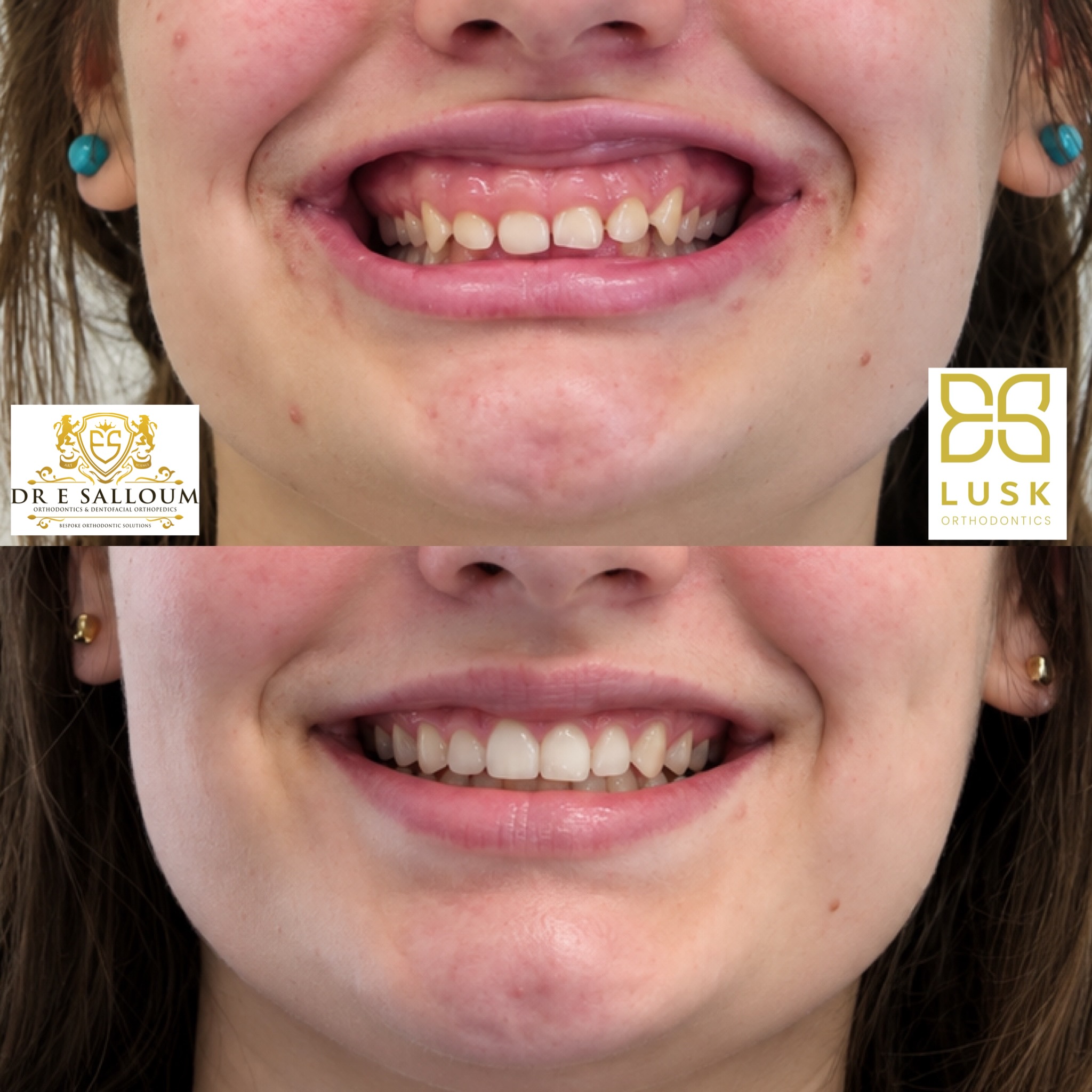 Non-surgical treatment of gummy smile in adult